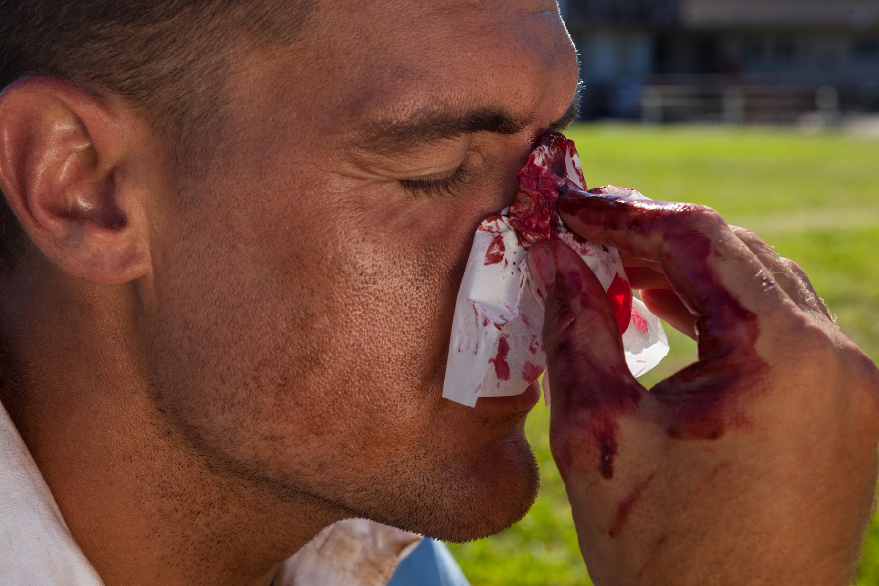 TXA tópico en epistaxis: 500 mg en gasa, tan efectivo como cauterización
